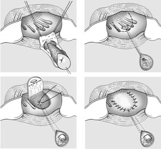 Analfisteln – Stadtspital Triemli Zürich